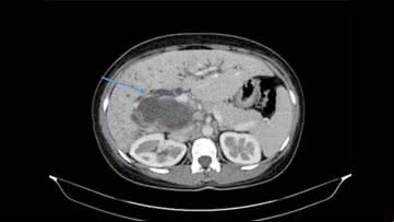 Médicos encontraram cistos de tênia no fígado da paciente - Divulgação/American Journal of Case Reports