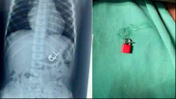 Criança engole cadeado com as chaves e a por endoscopia para remoção - Divulgação/Dra. Thaís Sampaio