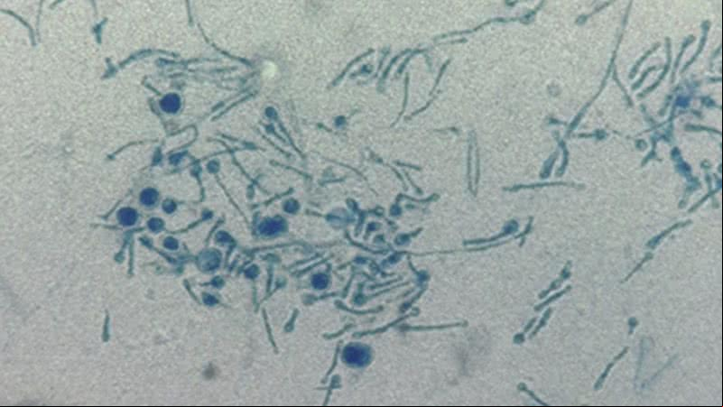 Os fungos encontrados no paciente - Divulgação/ Medical Mycology Case Reports
