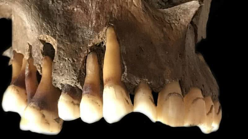 Uma amostra de DNA com herpes labial do século 17 - Universidade de Cambridge